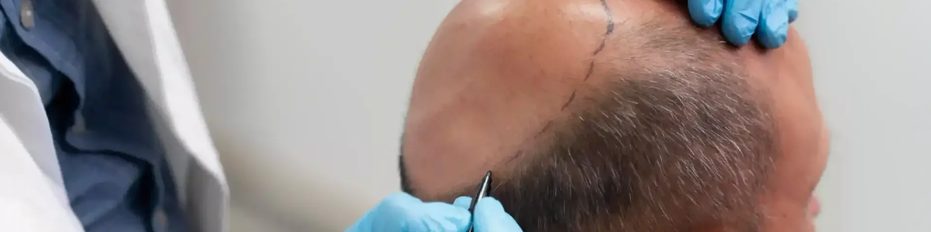 HAIR TRANSPLANTATION