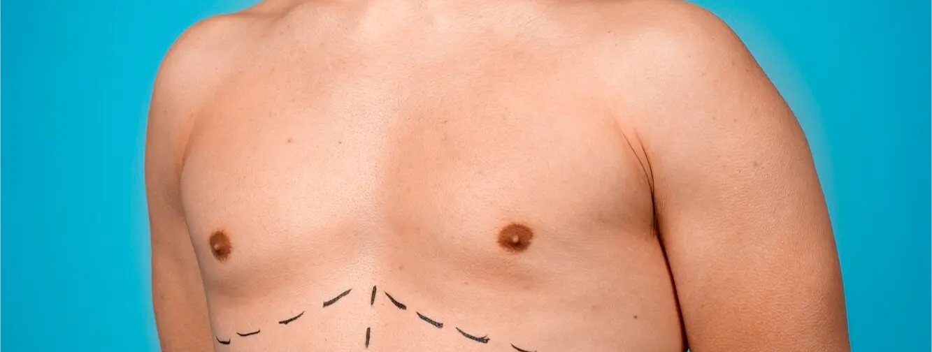Breast Lift